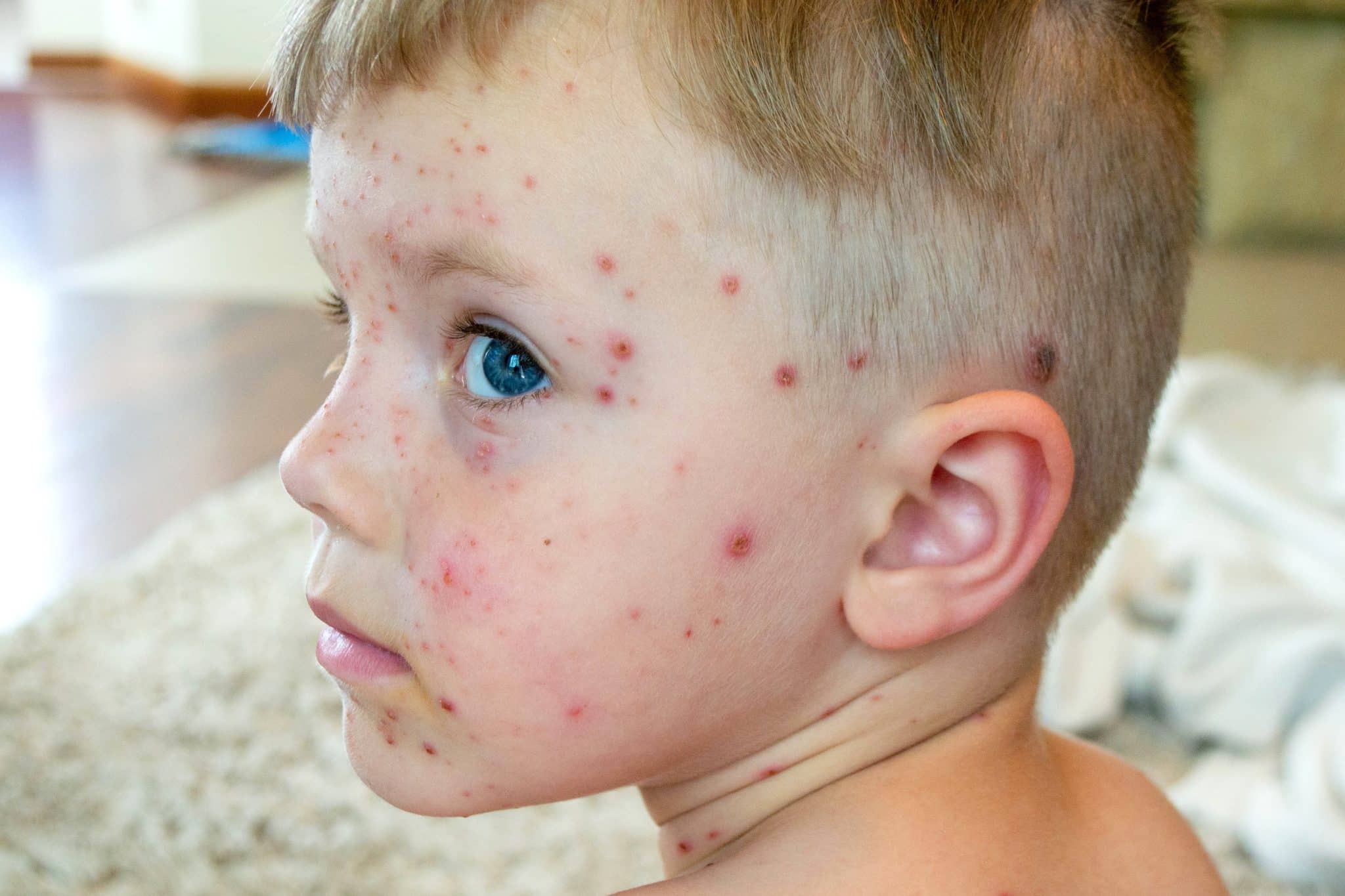 How Long Does Chickenpox Last Understanding The Duration And Stages Of