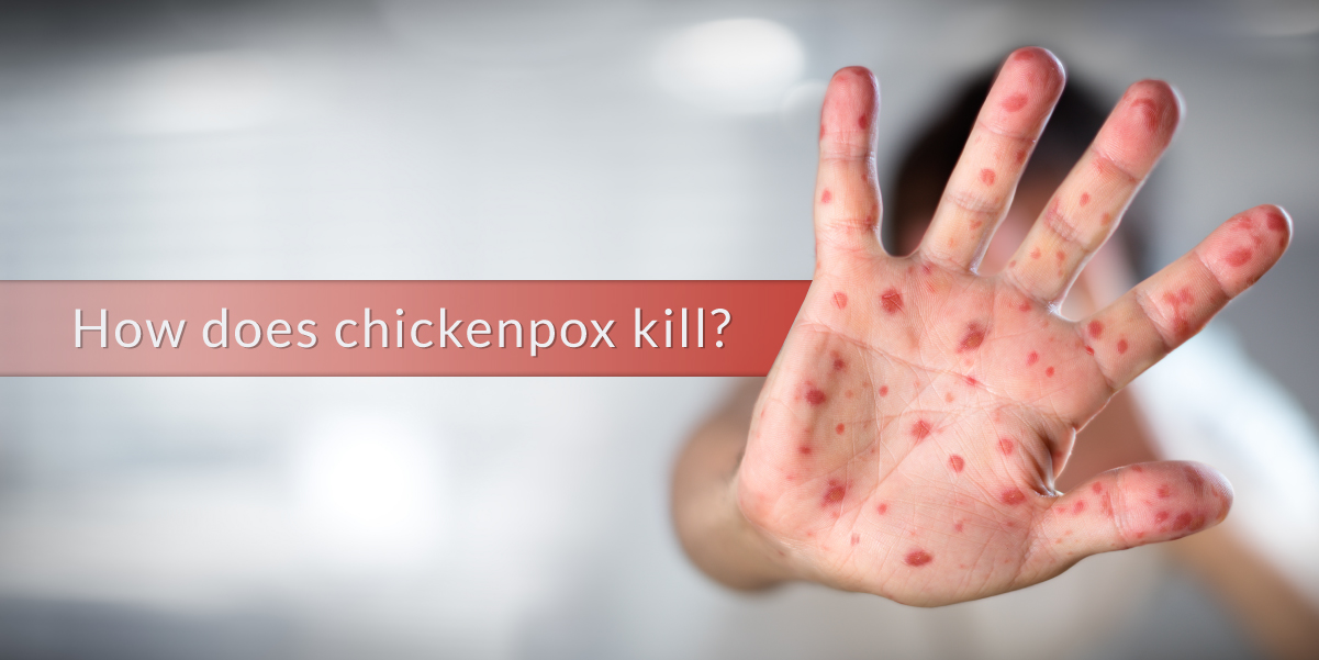 How_does_chickenpox_kill