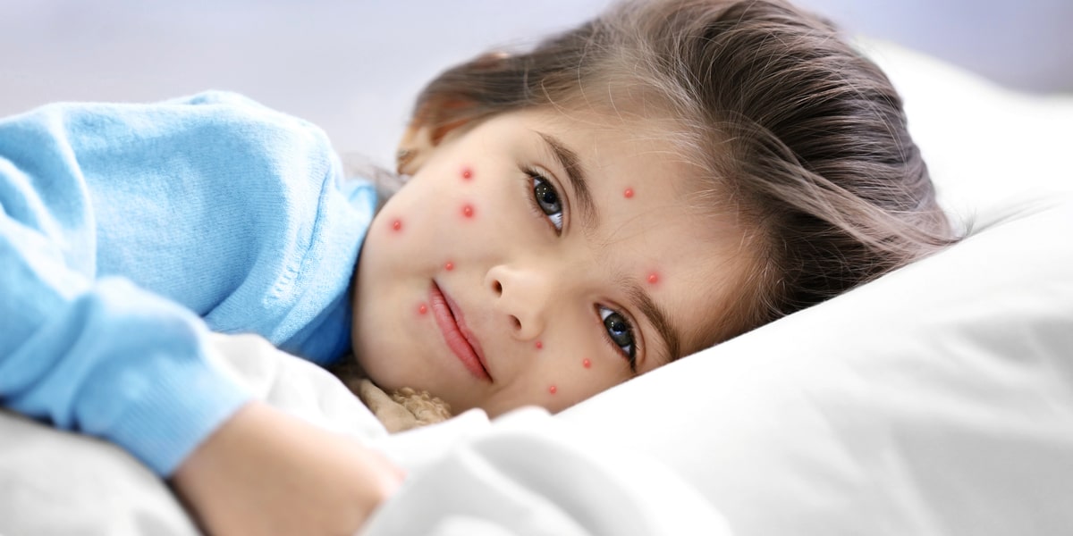 Myths_and_Facts_about_Chickenpox