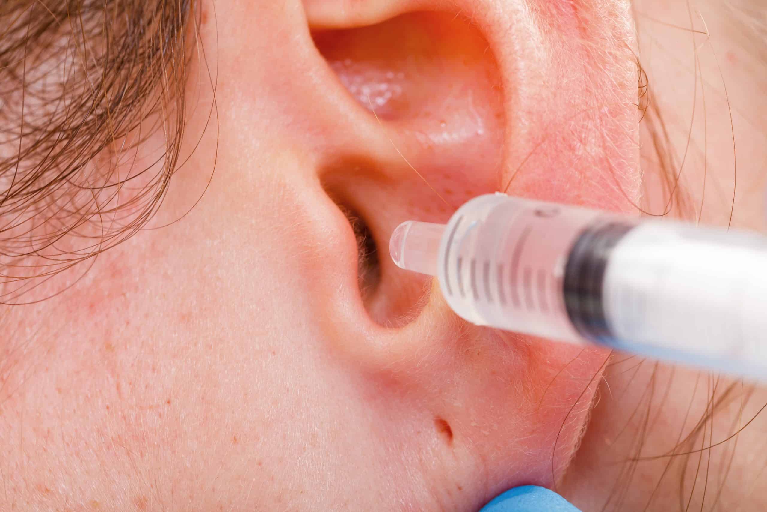 Почистить уши перекисью водорода в домашних