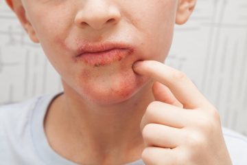 Identification and effective treatment of impetigo in children