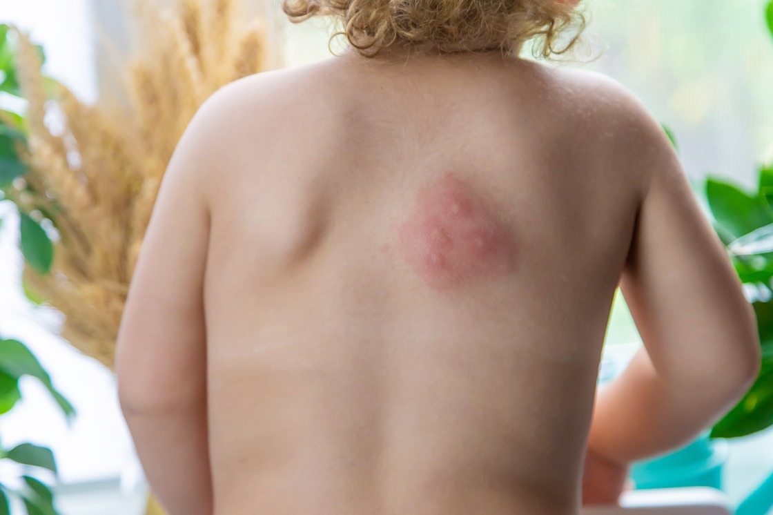 Signs-of-infection-in-insect-bites