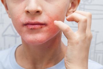 Early warning signs of impetigo