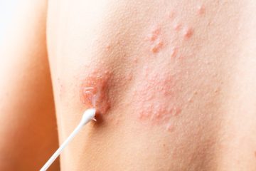 Effective methods for managing shingles