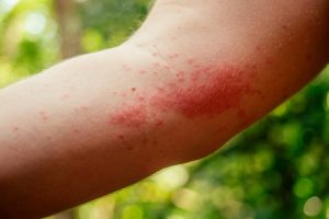 Expert tips for fast healing from insect bites