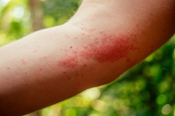 Expert tips for fast healing from insect bites