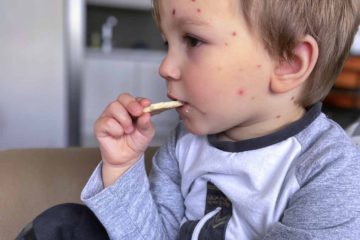 Isual comparison of chicken pox vs measles symptoms