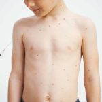 Important facts about chickenpox symptoms and effective treatments