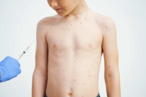 Important facts about chickenpox symptoms and effective treatments