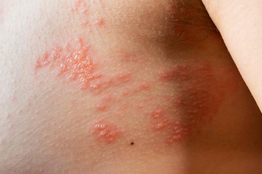 Shingles explained and the protection offered by the shingles vaccine