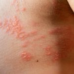 Shingles explained and the protection offered by the shingles vaccine