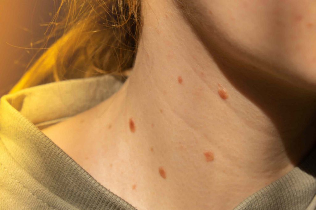 Signs indicating chickenpox infection