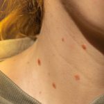 Signs indicating chickenpox infection