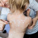 essential do's and don'ts for managing chickenpox effectively