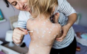 essential do's and don'ts for managing chickenpox effectively