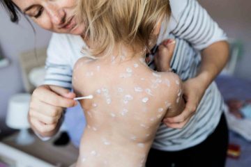 essential do's and don'ts for managing chickenpox effectively