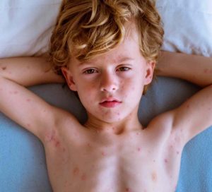 risk of shingles without previous chickenpox infection