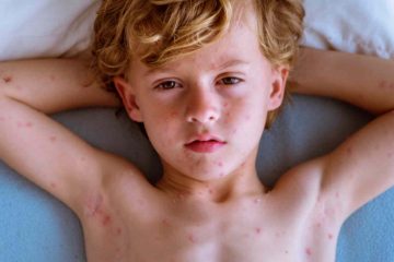 risk of shingles without previous chickenpox infection