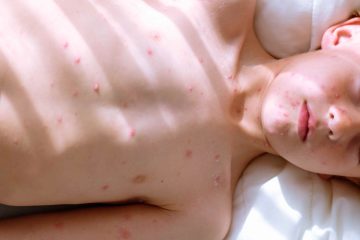 Understanding how the chickenpox vaccine protects you